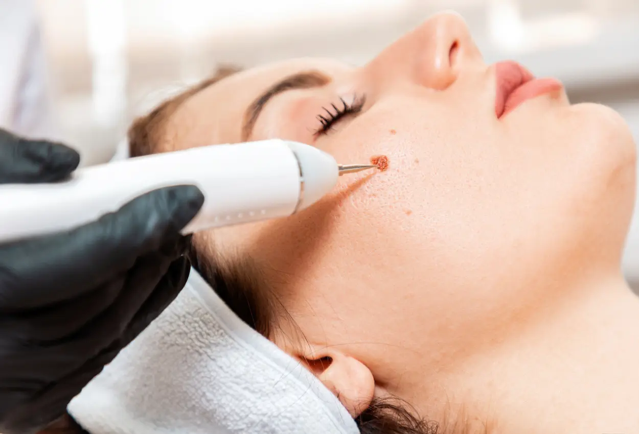 Frequently Asked Questions About Multiple Cryotherapy Treatments Scunthorpe