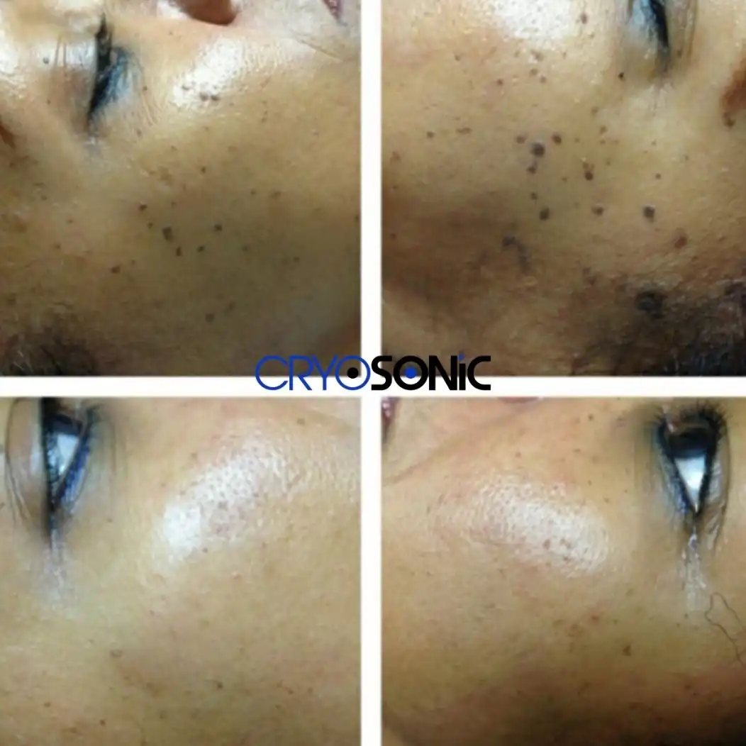 Why Skin Shows Pigmentation After Treatment Scunthorpe