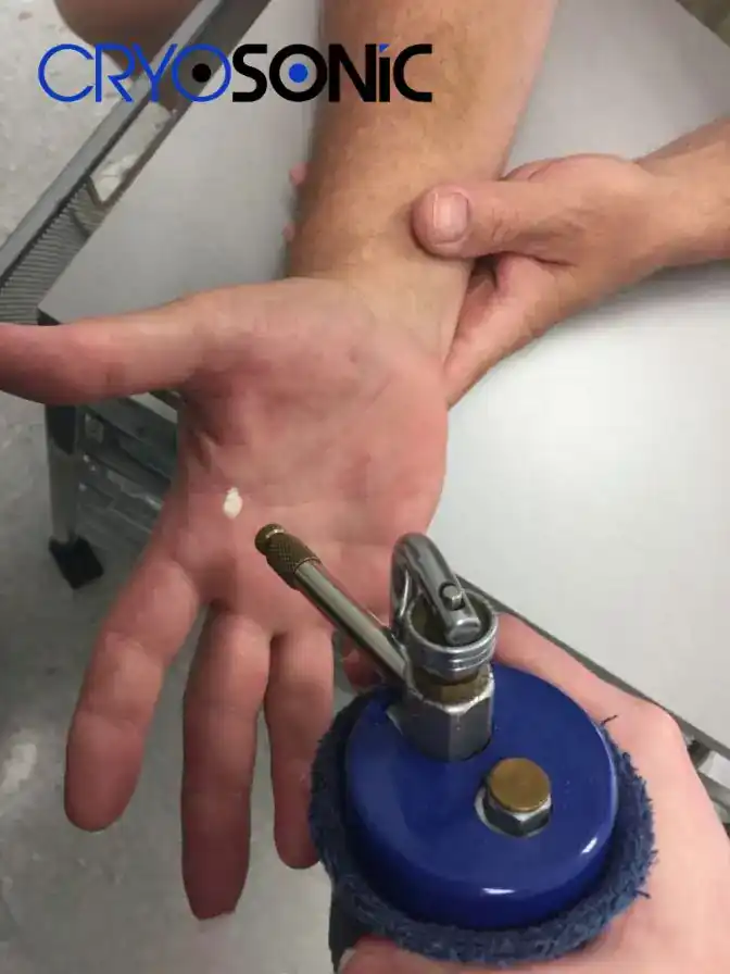 Temperature Differences: OTC vs Medical-Grade Cryotherapy Scunthorpe